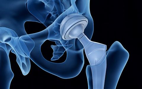 INDICAÇÕES PARA CIRURGIA DE PRÓTESE DE QUADRIL